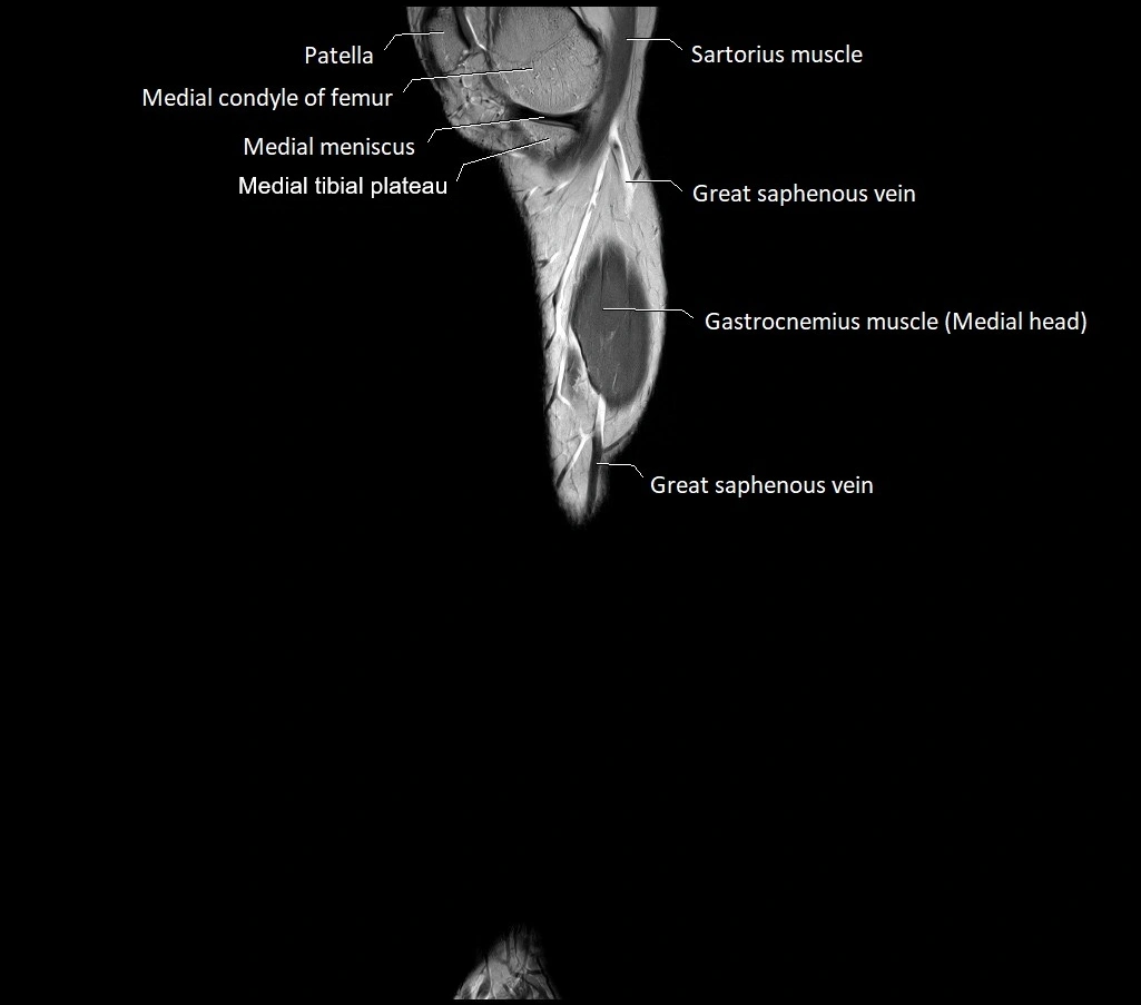 Lower leg sagittal anatomy 3T MRI image 27.webp